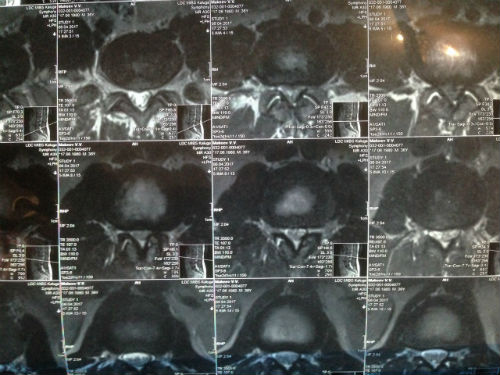 Расшифровка результатов МРТ краниовертебральной области