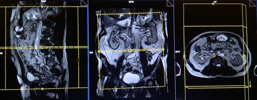 снимок мрт брюшной области с контрастом в 3х проекциях
