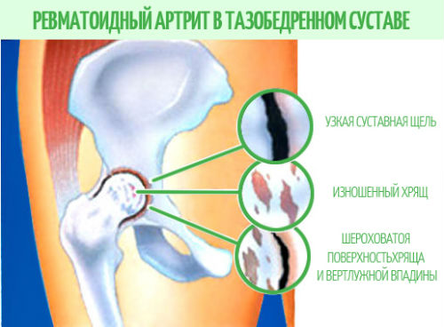 ревматоидный артрит