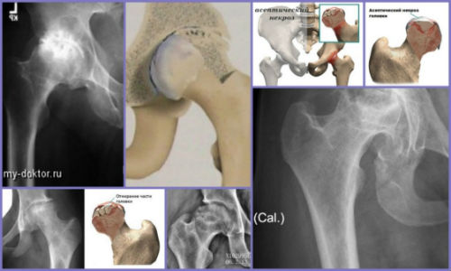 асептический некроз головки тазобедренного сустава