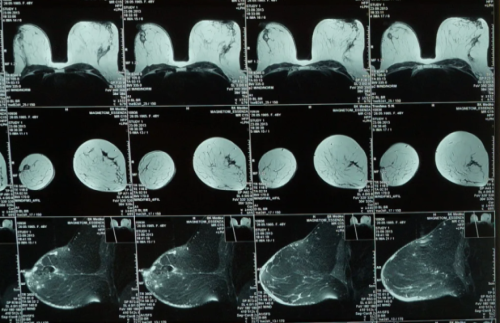 снимки МРТ молочной железы