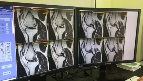 Мрт коленного сустава москва акции. Мрт коленного сустава. Снимок мрт коленного сустава. Мрт коленного сустава в Москве.