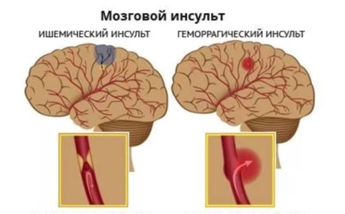 Инсульт мозга на МРТ